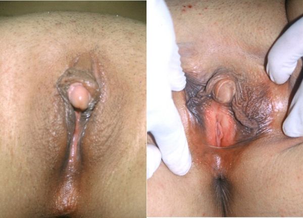 labia clitoris