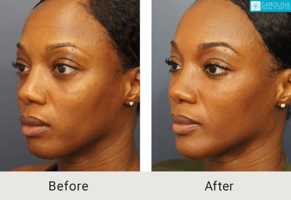 fat grafting for neck