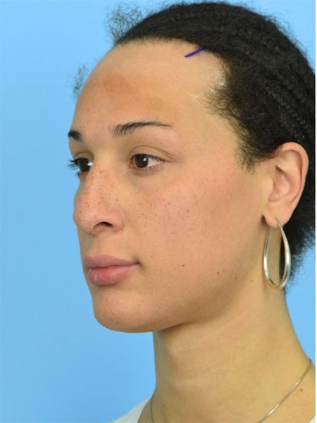 fat grafting for malar edema