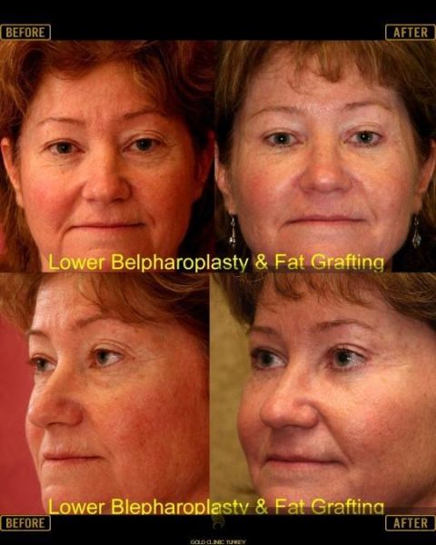 dermal fat grafting to lips