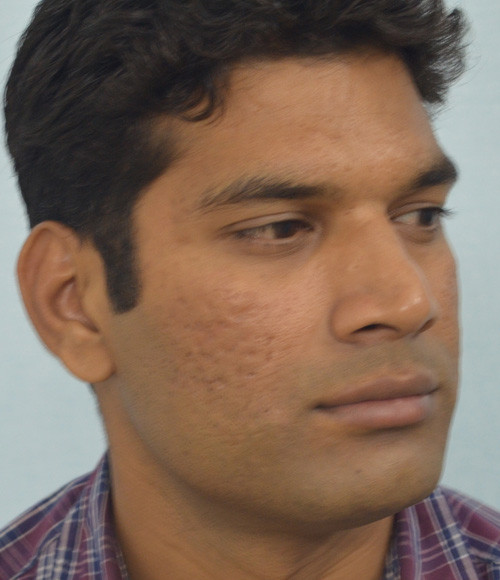 lipofilling before after