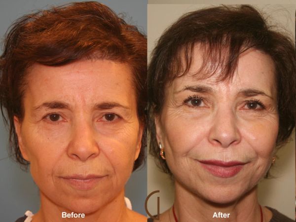 fat grafting after melanoma