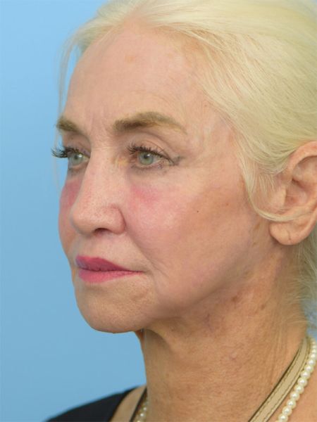 skin resurfacing before and after