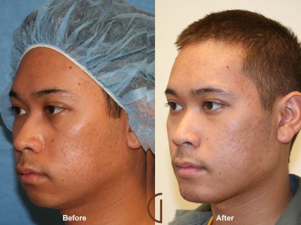 collagen injections before and after