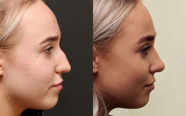 hair transplant