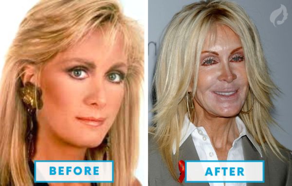 after botched plastic surgery