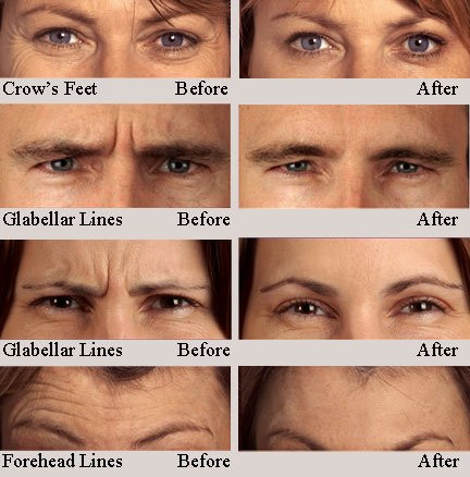 botox injection areas