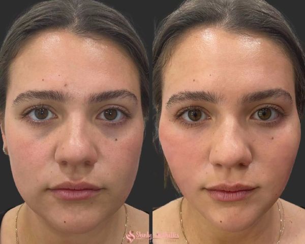 ozempic for weight loss