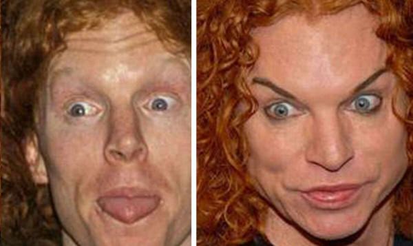 famous people who got plastic surgery