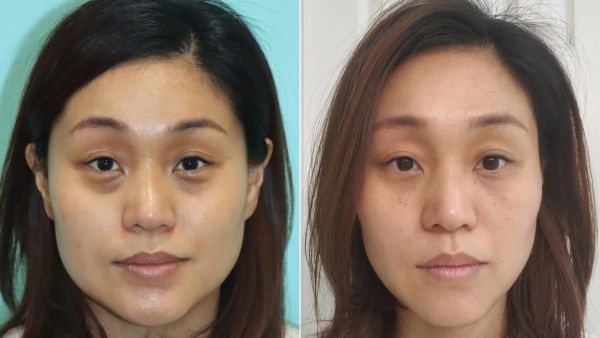 dysport botox injections