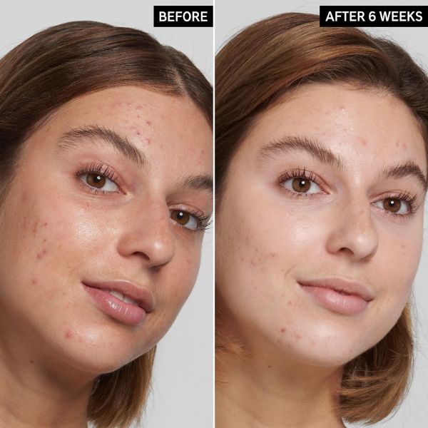 botox before and after