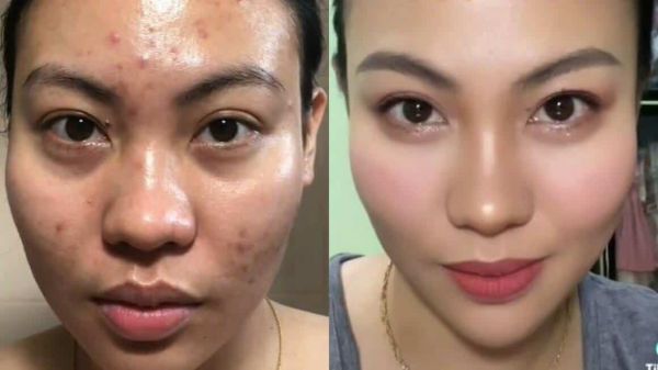 micro needling before and after