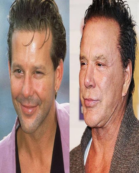 mickey rourke after plastic surgery