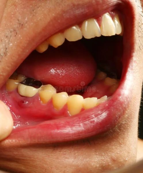 petechiae