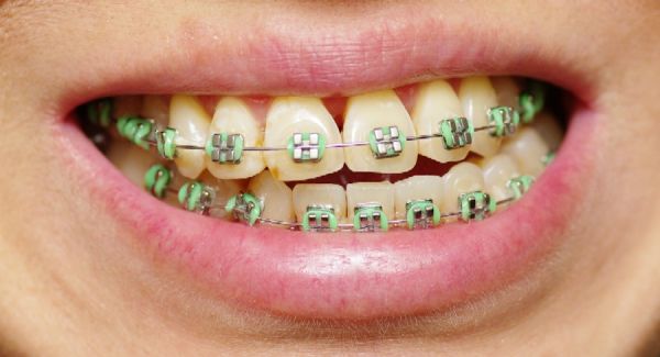 pretty smiles with braces