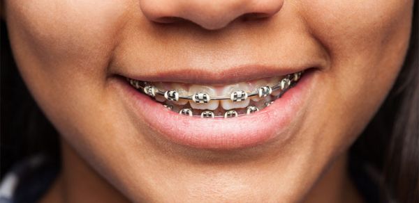 overbite braces