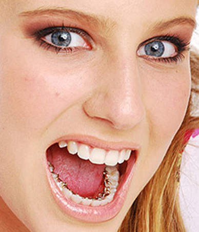 piercings with braces