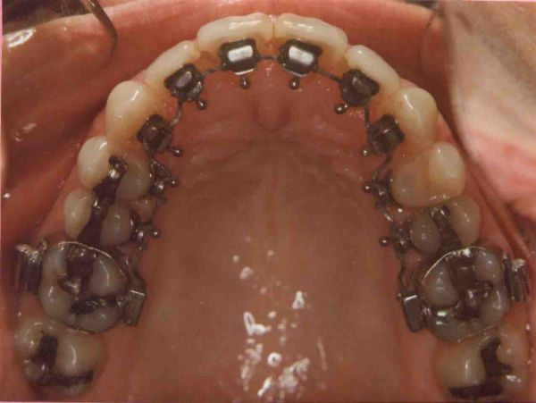 for your teeth
