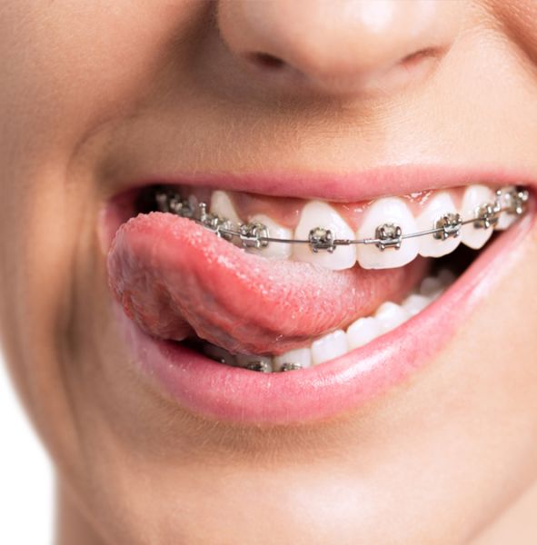 metal mouth