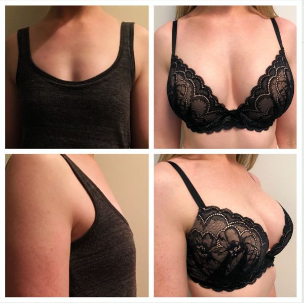 small b implants