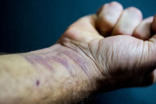 bruise on elbow