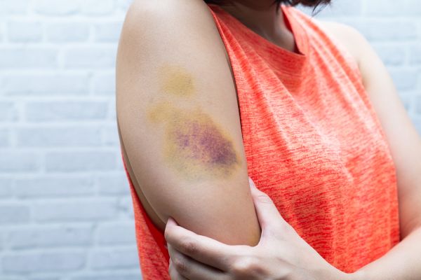 rheumatoid arthritis wrist