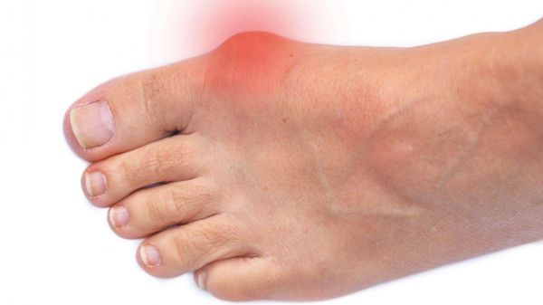 callus