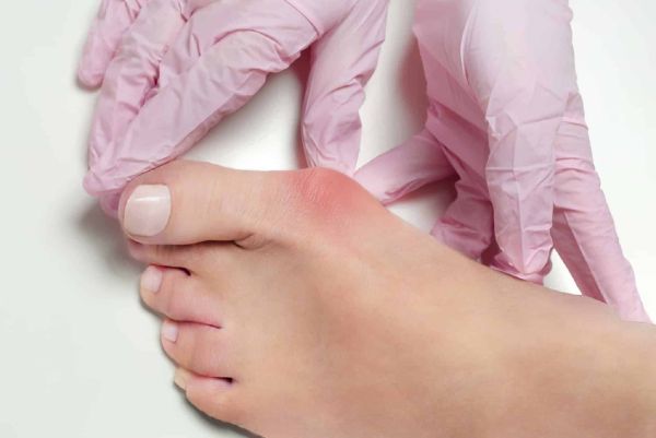 bunions on bottom of feet