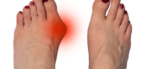 vs normal foot