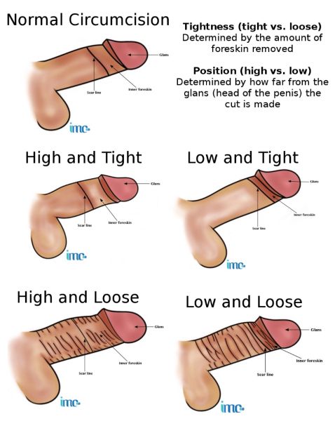 phimosis adhesion