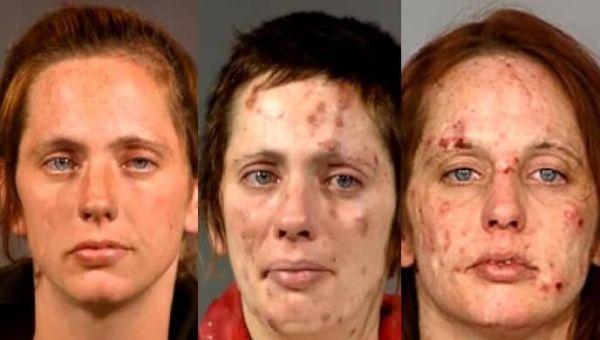meth crystalizing under skin