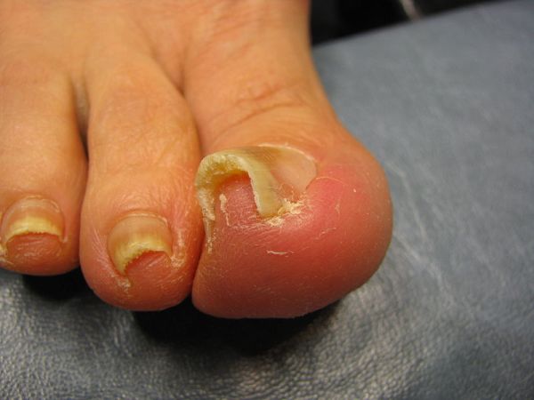 hammer toe treatment