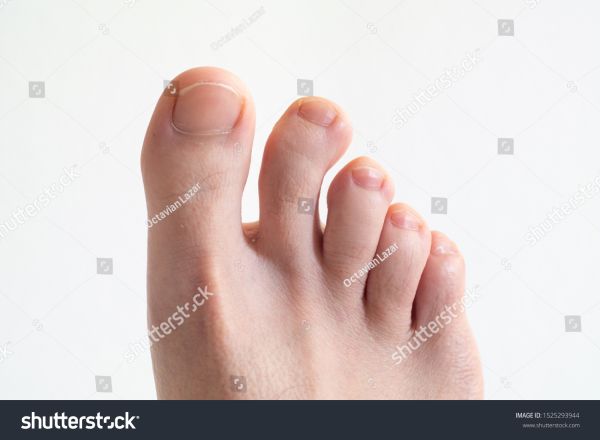 gnarly toes