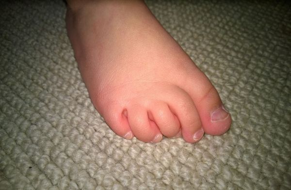 ingrown toenail big toe
