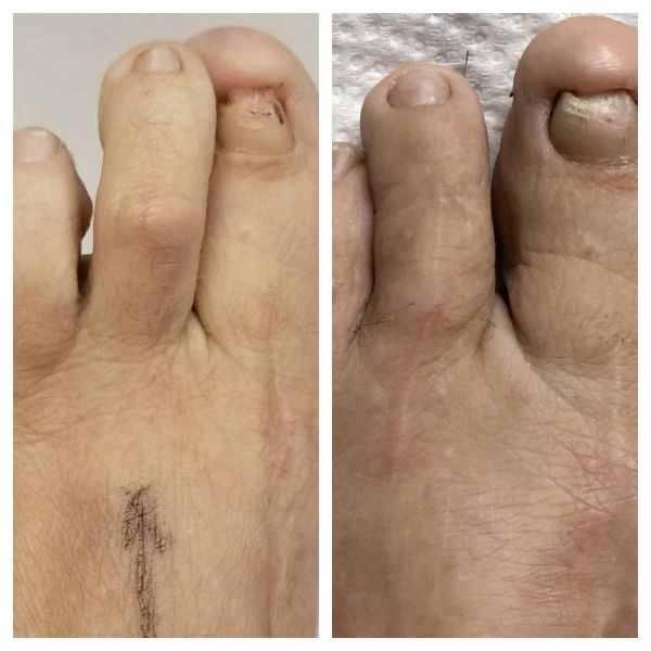 curling your toes