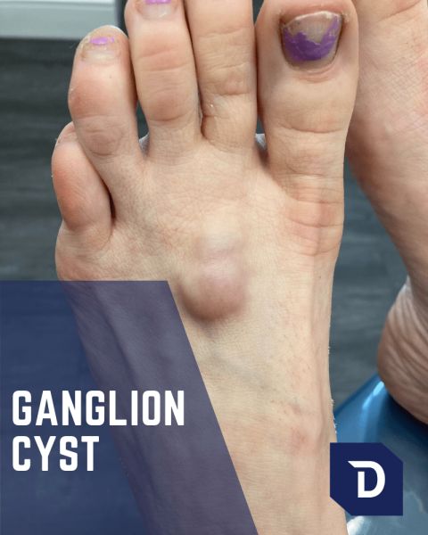 ganglion cyst on b union