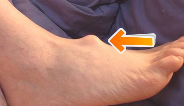 ganglion cyst ankle mri