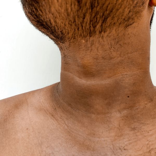 weird discoloration of skin on right side of neck