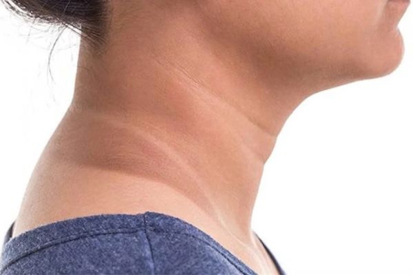 sun spots on neck