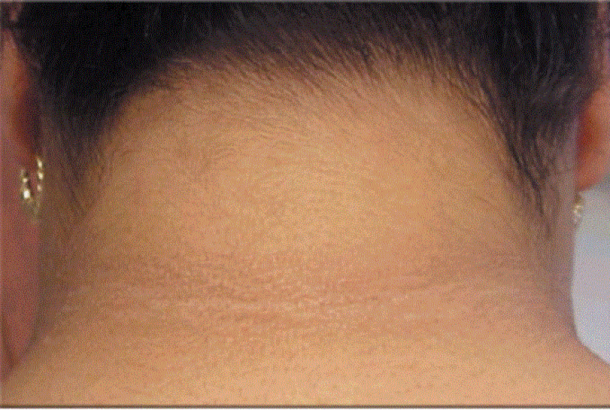 upper lip discoloration