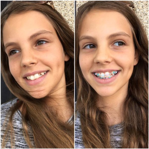 blogger braces