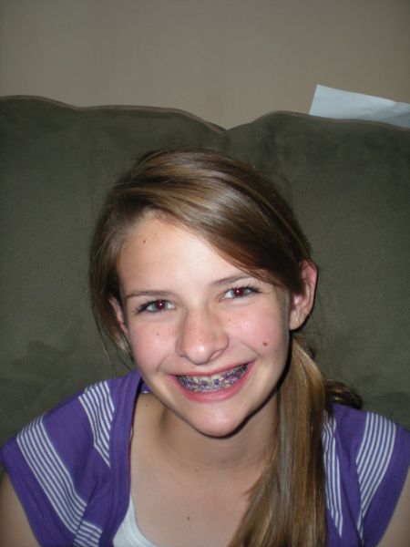 dental braces before and after