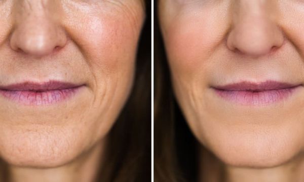 dehydration lines around mouth