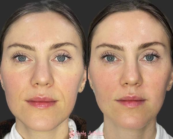 botox for mouth wrinkkles