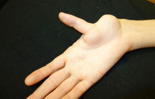 hand birth defects