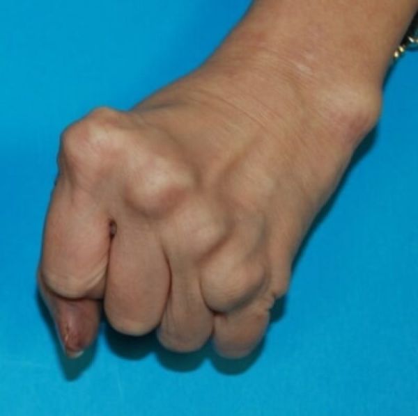 swollen finger joints arthritis