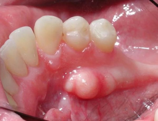 tori dentistry