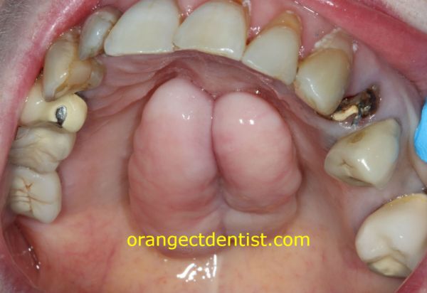 toro mandibular