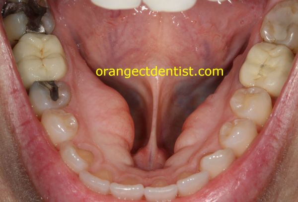 overbite