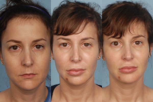 lipodissolve injections
